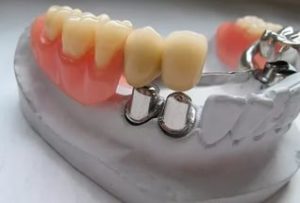 Image - DIY dental bridge repair