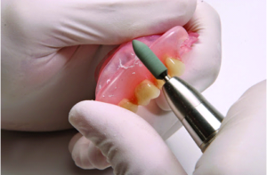 Image - DIY dental bridge repair