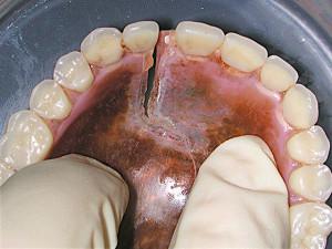 Image - DIY dental bridge repair