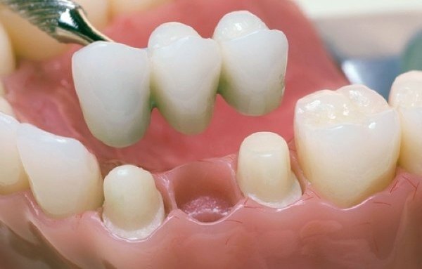 Image - DIY dental bridge repair